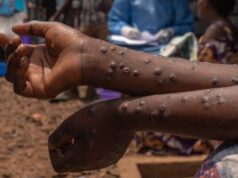 Suspected Mpox case reported in Isiolo